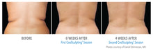 coolsculpting