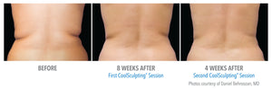 coolsculpting